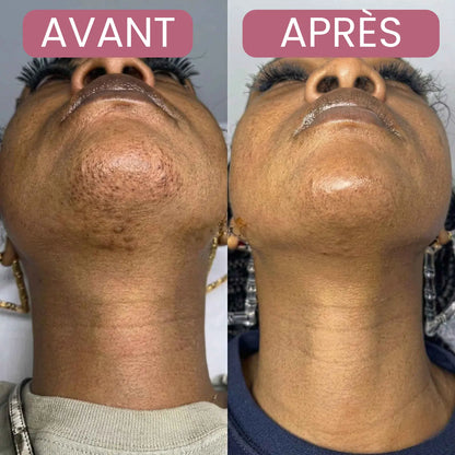Sérum inhibiteur de croissance des poils - Cyperus Rotundus